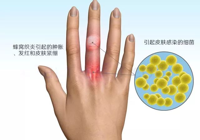 蜂窝织炎是一种常见的细菌性皮肤感染.