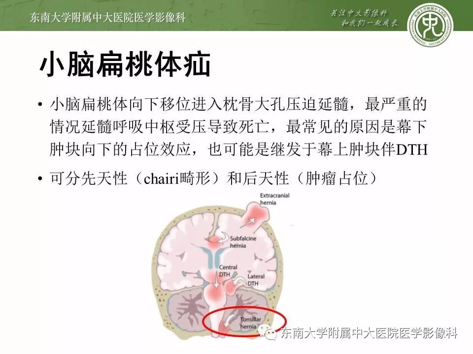 右侧岛颞叶出血伴小脑幕切迹疝(病例2) 责任编辑