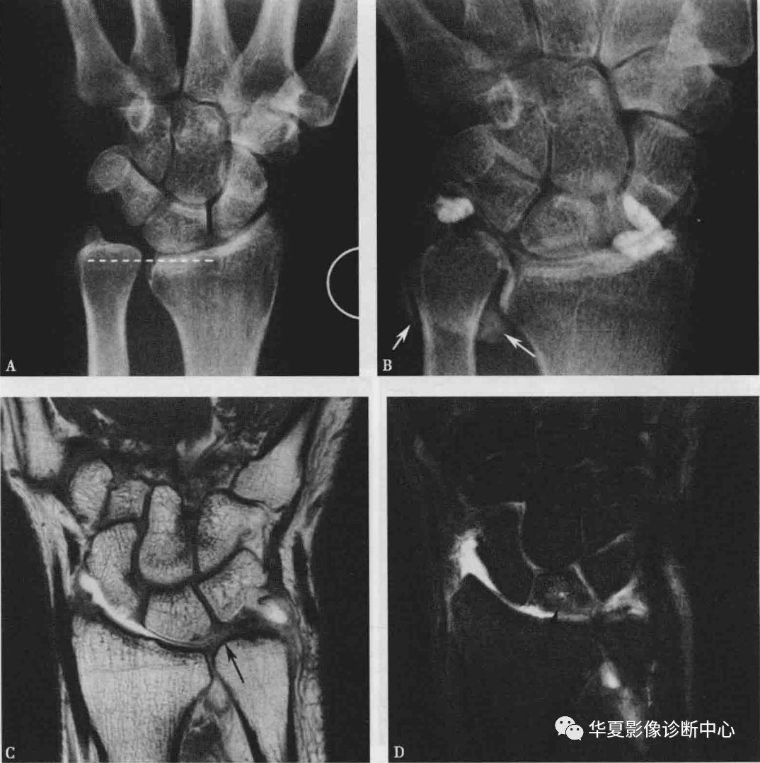 b图关节造影显示桡腕关节与远端桡尺关节关系异常,提示三角纤维软骨