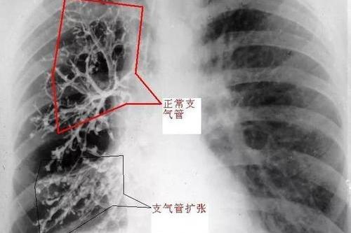 关于支气管扩张患者 生活上要注意这些细节