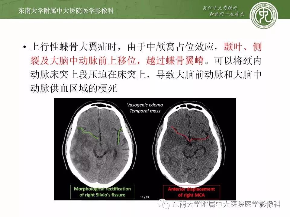 右侧岛颞叶出血伴小脑幕切迹疝(病例2) 责任编辑