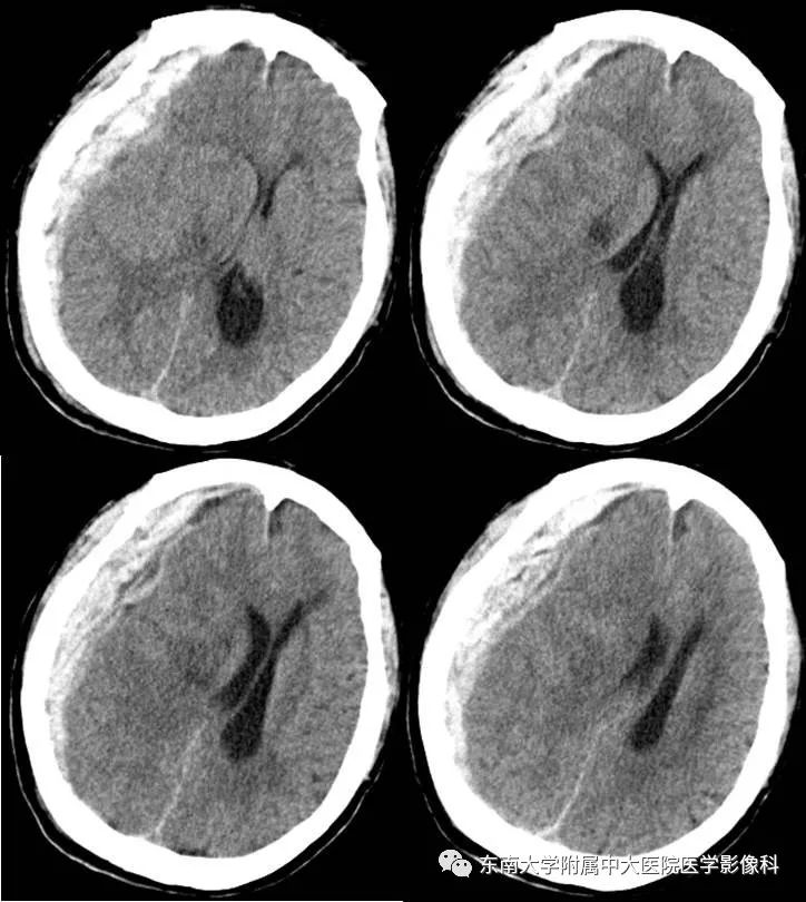右侧岛颞叶出血伴小脑幕切迹疝(病例2)