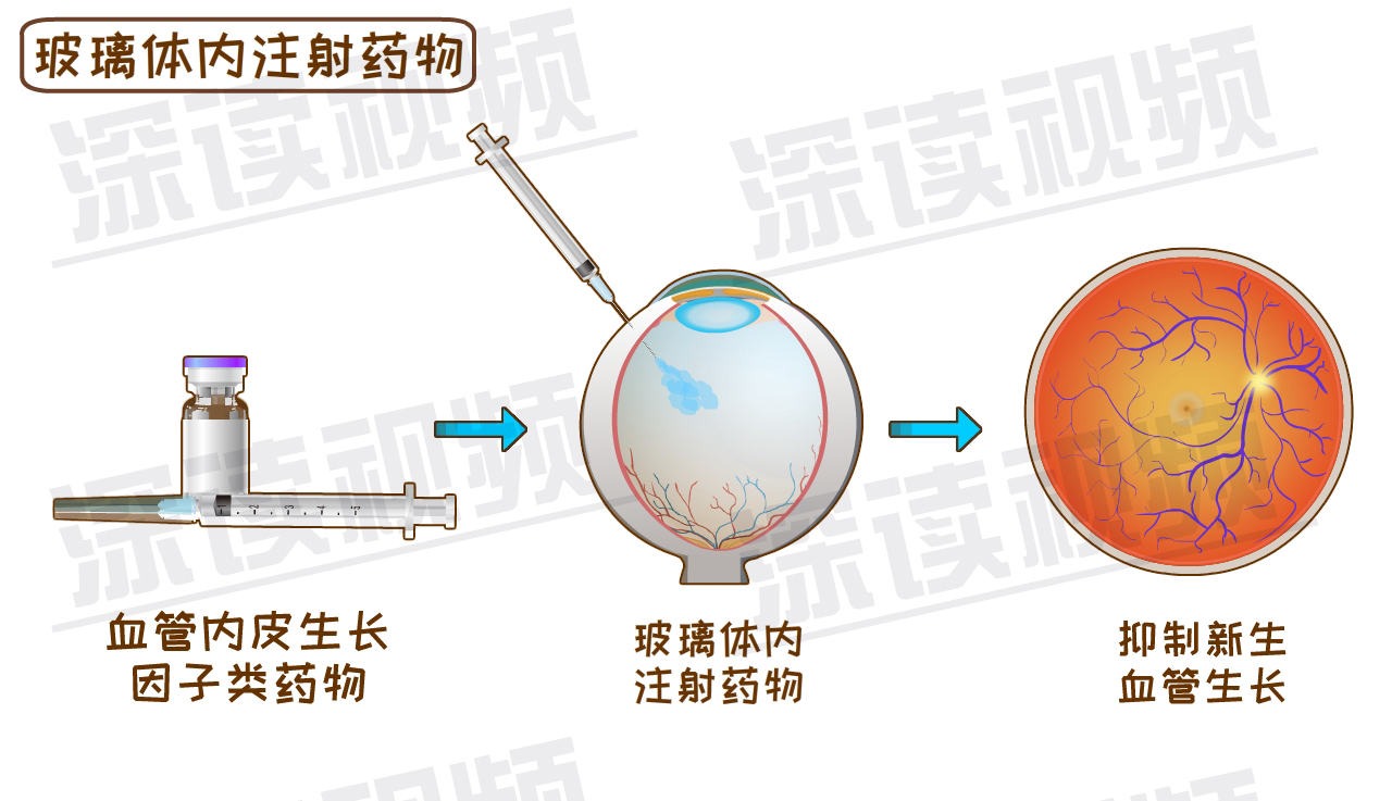 玻璃体切割手术的原理_175眼科玻璃体切割术的健康宣教