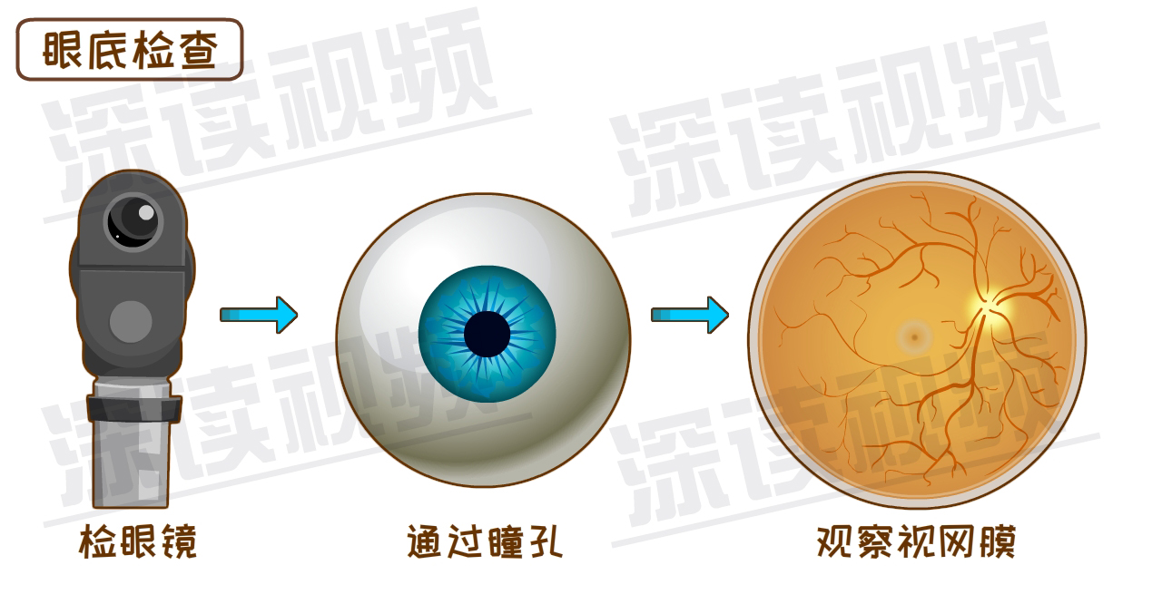 玻璃体切割手术的原理_175眼科玻璃体切割术的健康宣教