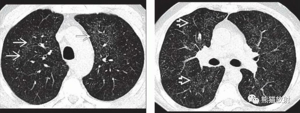 病毒性肺炎丨ct表现,诊断要点_小叶