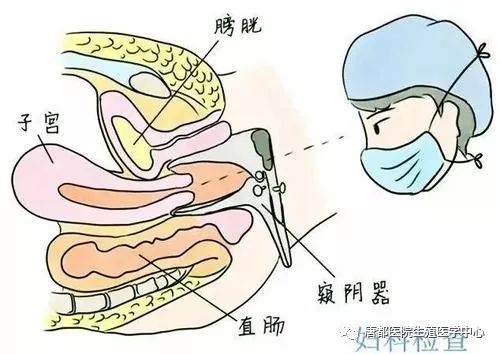 妇科检查也叫盆腔检查,主要包括会阴部视诊,窥器检查,双合诊,三合诊