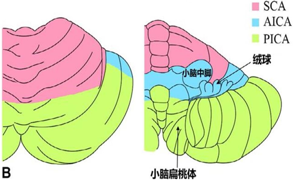 【纯干货】一文读懂小脑梗死的定位诊断