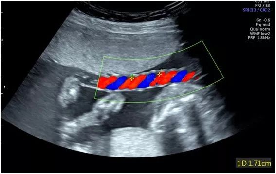孕30周,局部脐带螺旋指数0.58 (30周