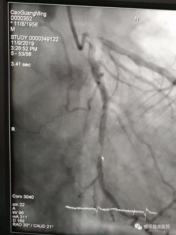 肖春林,袁洁,林丽妍等上台配合,冠脉造影结果提示冠脉3支病变,回旋支