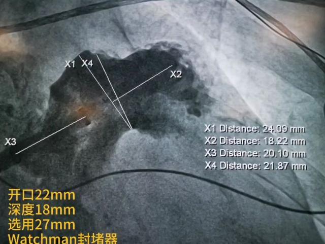 郑大二附院心内科成功开展首例左心耳封堵术