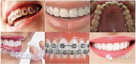 成都口腔科普：牙齿矫正的时间能缩短吗？