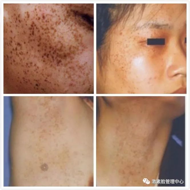 你们理解的"表皮斑"够全面吗?很适合自己学习!