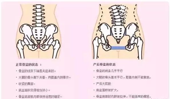 【东莞骨盆闭合】:女性产后修复的基础