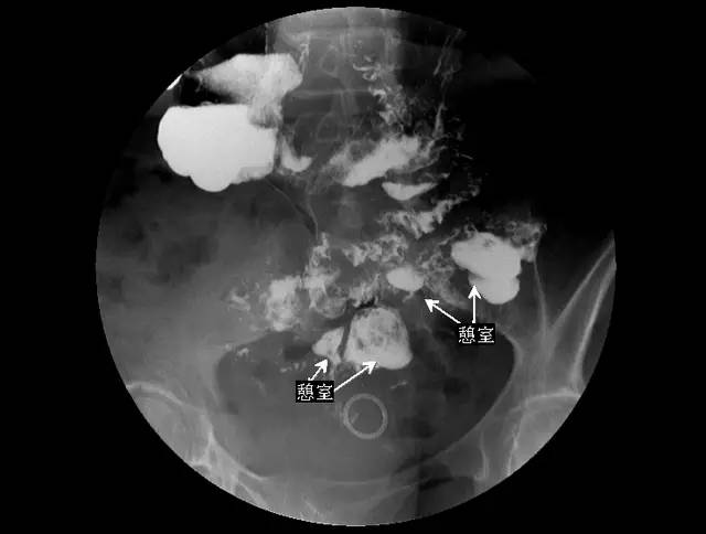 掌握肠道造影看这篇就够了