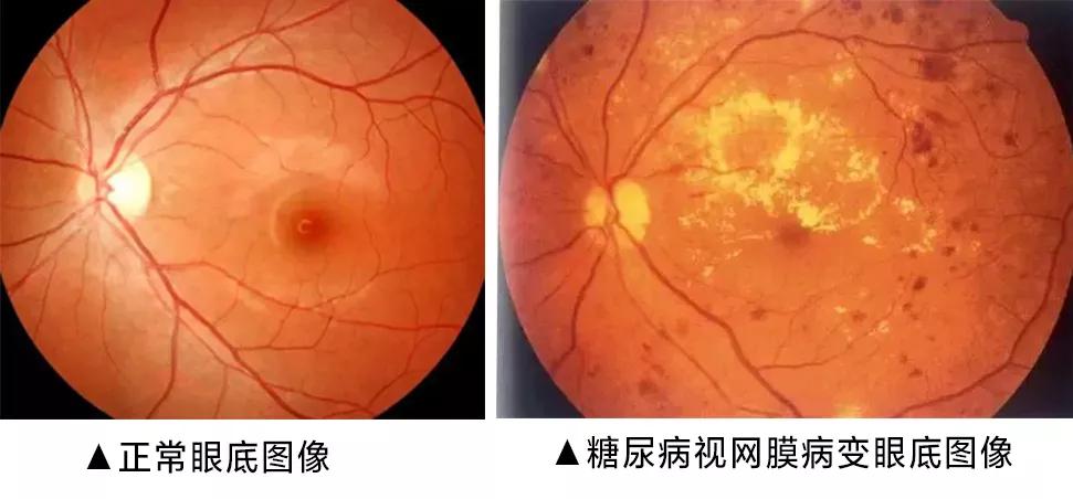 严重者在视力丧失的同时会导致顽固的新生血管性青光眼,患者会出现