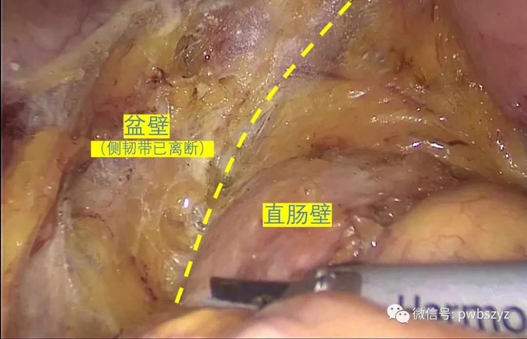 大话大肠癌第二季第十五集直肠tme核心系膜与非核心系膜解剖实战