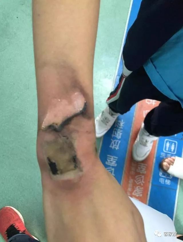 【可怕】智能电话手表突然自燃,广东一小学生手腕被烫伤.