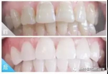 什么时候要换一次牙 3cbdd1de02ba4c8d83f17aed505ff4db.jpeg