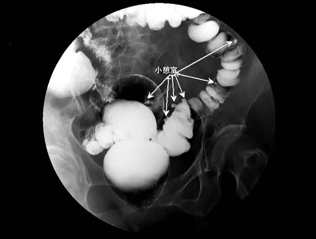掌握肠道造影看这篇就够了