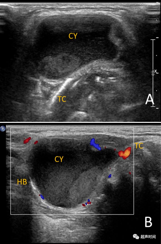 甲状舌管囊肿:浅显易懂,但超声知识点都在