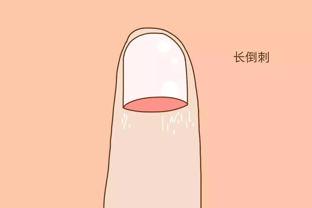 【生活窍门】手指倒刺怎么办 如何预防手指长倒刺
