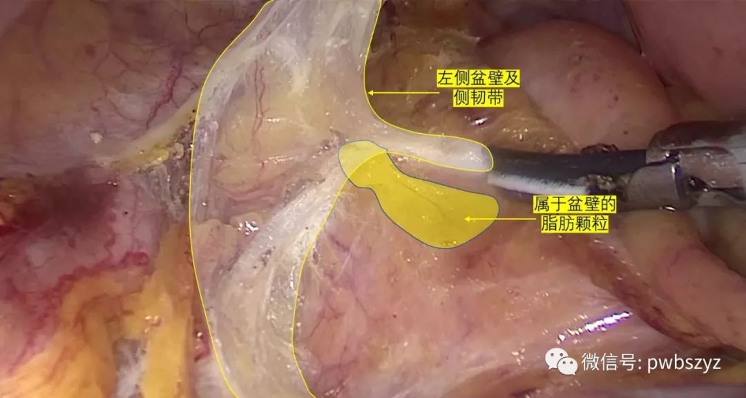 《大话大肠癌》第二季 第十五集 直肠tme核心系膜与非核心系膜解剖