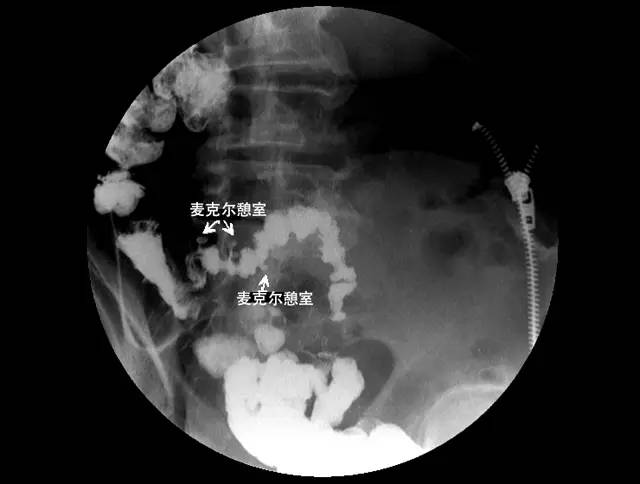 小肠插管双对比检查的 x 线影像特征有:回肠远段突向肠腔外,有与肠管