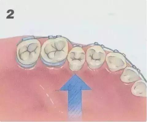 戴牙套什么原理_戴牙套的图片(3)