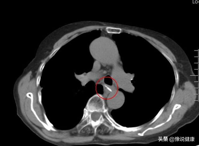 食管异物郑权主任可是取了不少,这个ct下高亮度异物到底是什么:骨头?