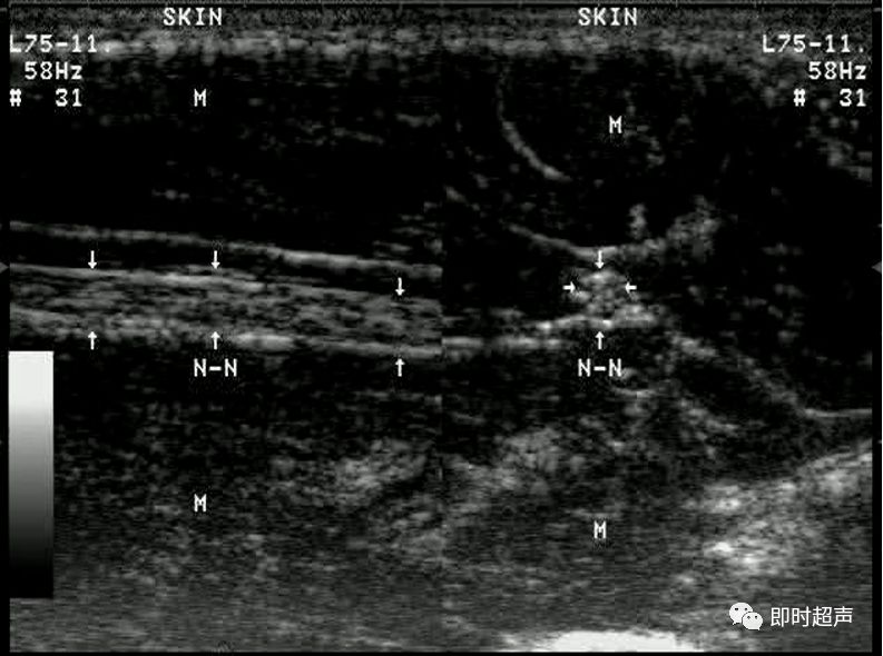 正常周围神经超声声像图特征