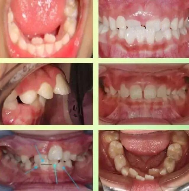 [肥猪嘟嘟]孩子牙齿畸形要等到12岁以后才矫正？儿童矫正了解一下！