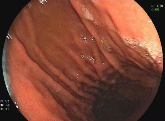 吃什么东西容易产生结石 5d671b9e2b1f4bd38eb6dc8ff05b29f4.jpeg