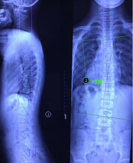康睿仕运动康复中心:得了脊柱侧弯还可以做运动吗?通过案例解析