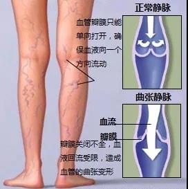 腿上出现"青筋"是怎么回事?太原医大医院周围血管外科医生为您解答