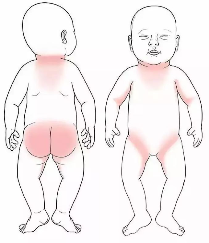 [崔玉涛的育学园]没想到！孩子冬季也易长痱子，教你3个护理绝招！