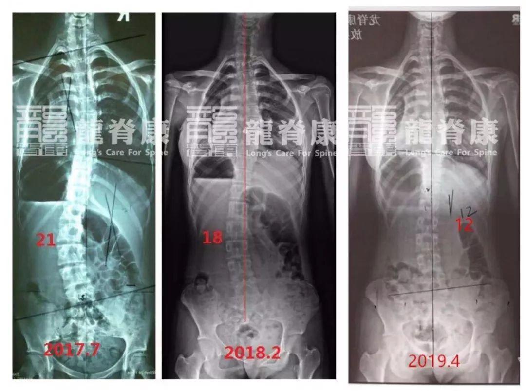 孩子戴支具前后x光片对比