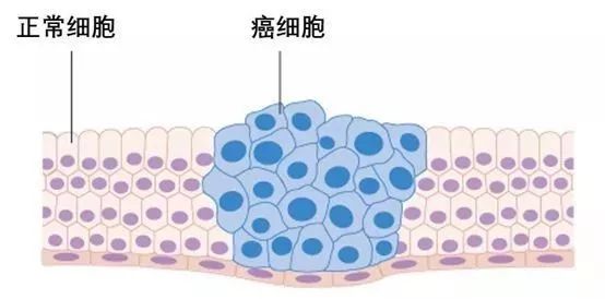 将想要癌变的叛乱分子清除出去,因此正常细胞发展成癌细胞并不是一蹴