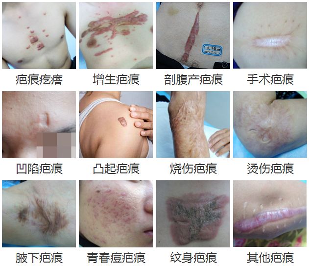 疤痕可分为许多种类,增生,凹陷,瘙痒,疼痛……不同类型的疤痕,症状也