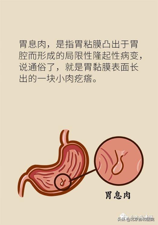 胃息肉会癌变吗?要手术切除吗?听协和医生说说看!