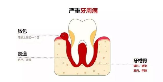 牙龈脓包怎么回事?