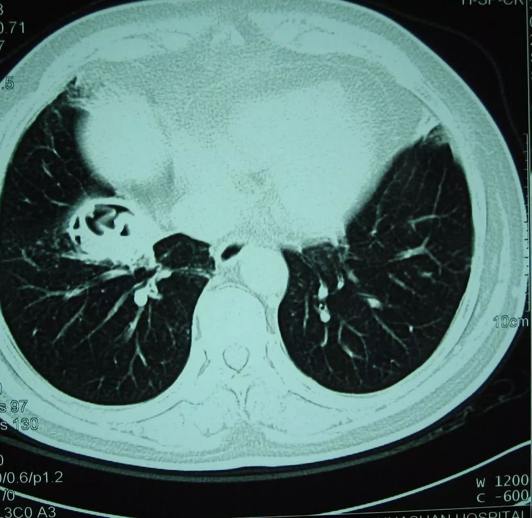 图6 肺包虫病今天表面上谈的是如何根据一张胸部ct来判断病原学诊断