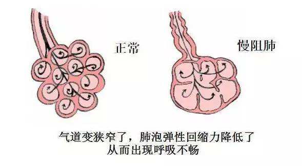 世界慢阻肺日 沈阳燕都告诉你如何远离慢阻肺