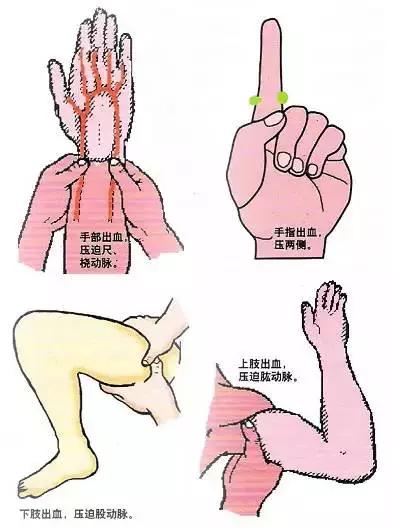 ②直接压迫止血法用无菌纱布直接压迫伤口处,压迫约10分钟.