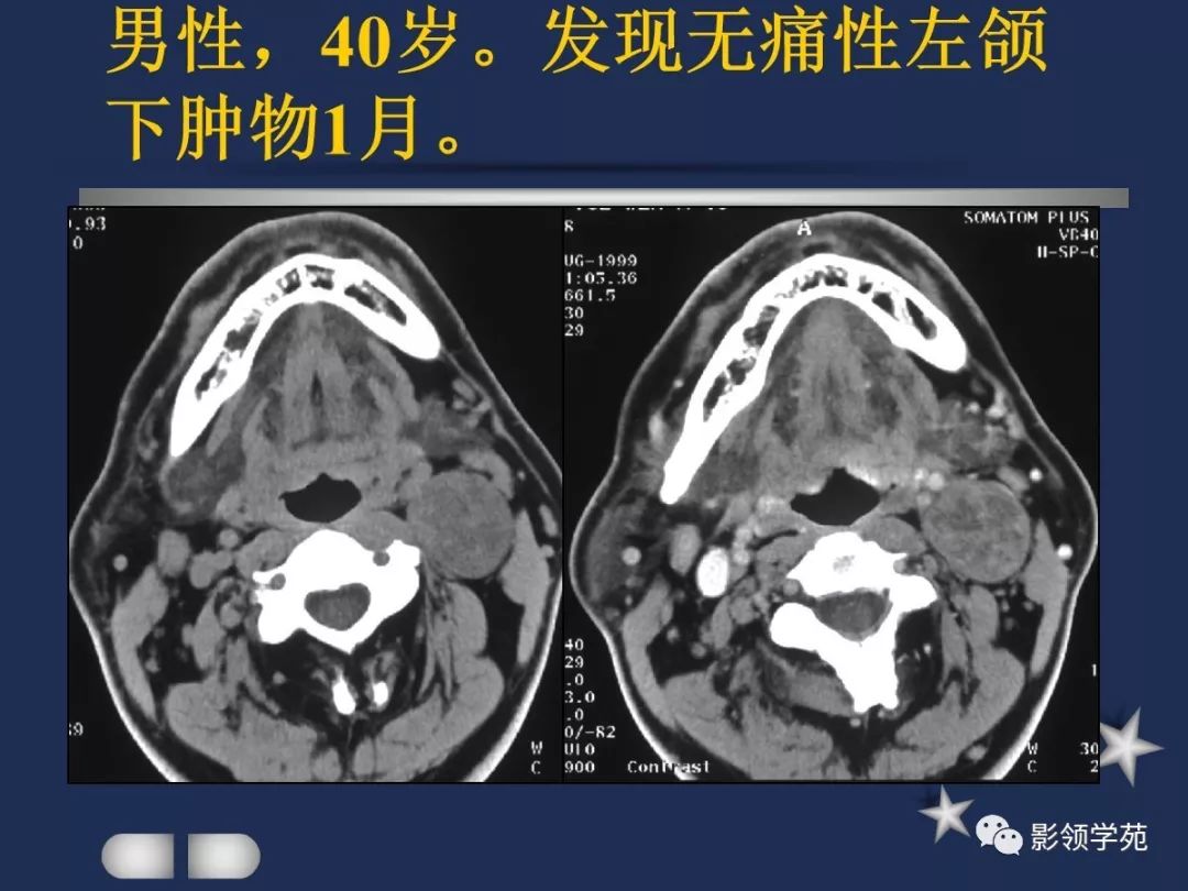 腮腺颈部疾病影像诊断