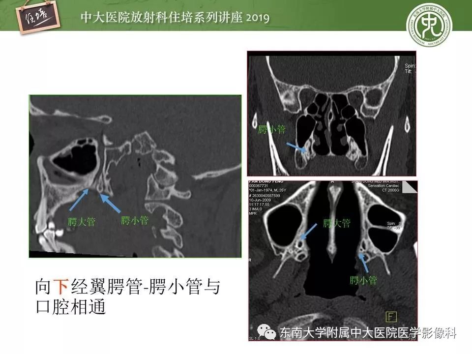 2019住培系列讲座第85期翼腭窝的影像解剖及临床意义