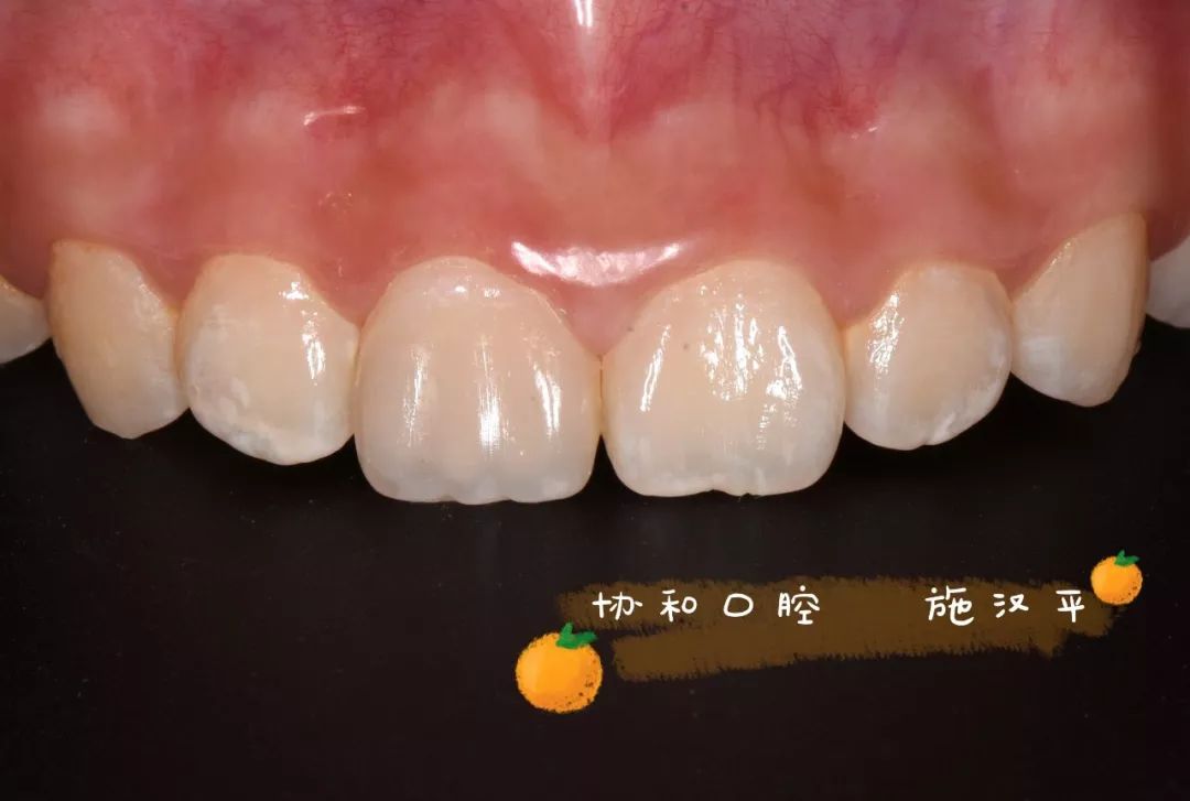 纳美树脂a3o色完成牙本质发育叶的堆塑,用a1 色,a2色完成整体修复对