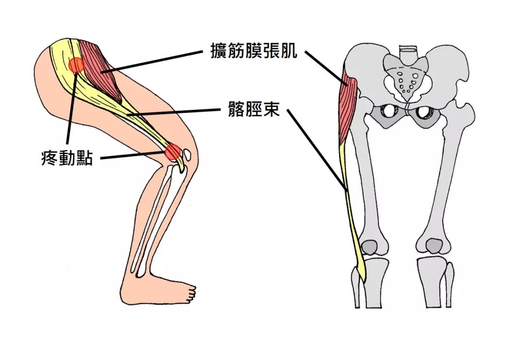 遭遇了髂胫束综合征该怎么办