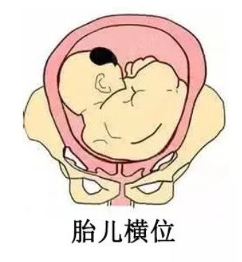 荆州江京妇科医院▏想要顺产,却发现胎位不正怎么办?