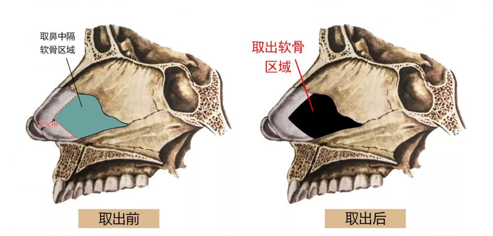 鼻整形功课鼻中隔软骨能不能取取了之后会有什么风险