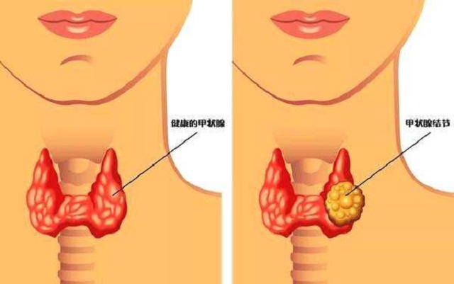 甲状腺结节为什么会出现钙化?